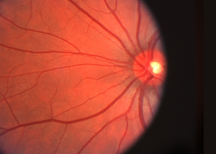 Diabetes & Diabetic Retinopathy in Edmonton